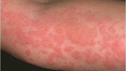 Как выглядит аллергический дерматит фото
