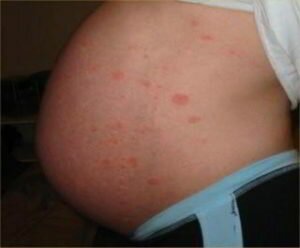 Атопический дерматит у беременной