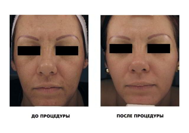 Фотоомоложение лица до и после