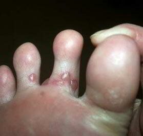 Мокрый грибок между пальцами ног